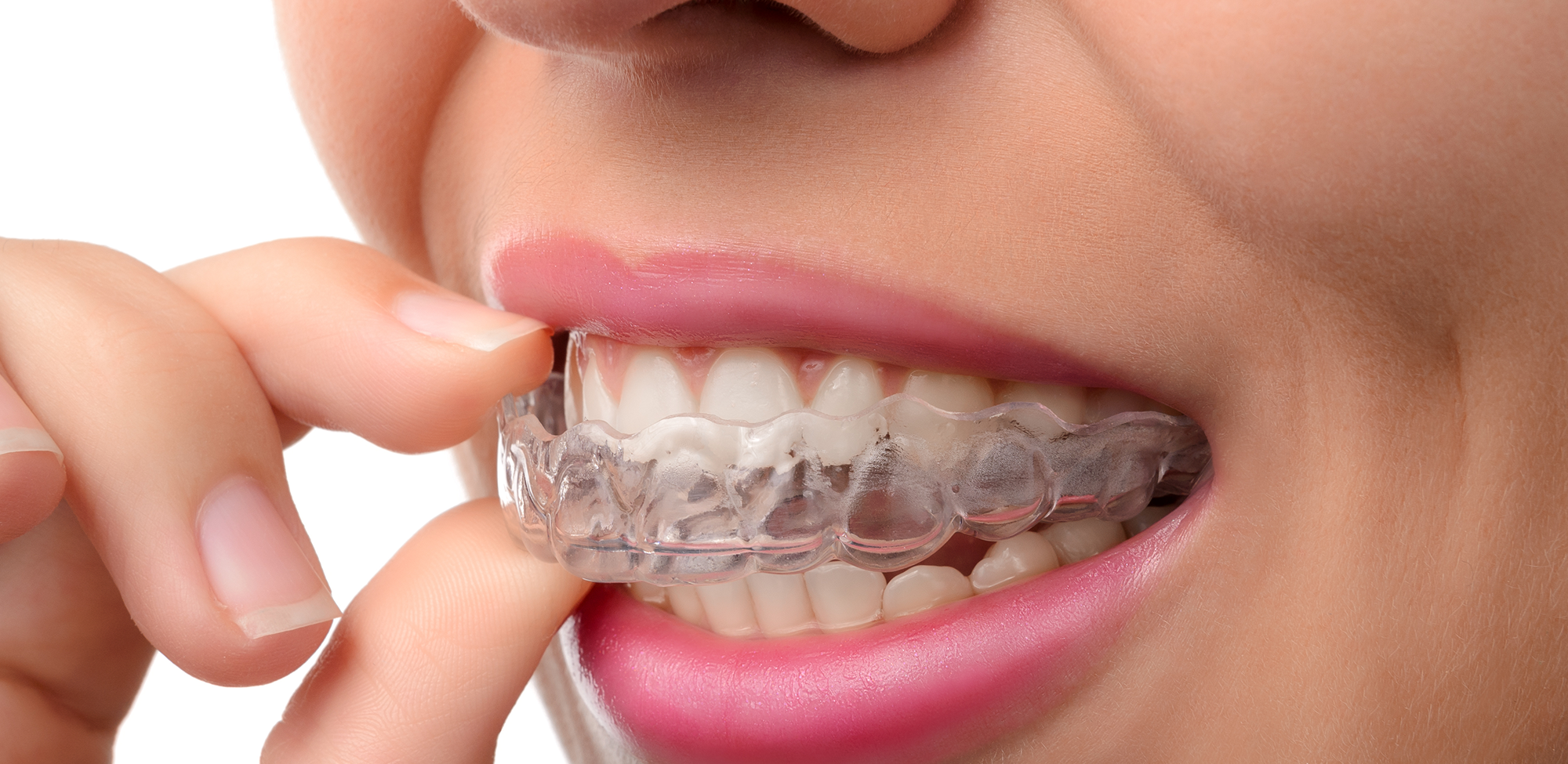 A mouth showcasing the Invisalign retainers