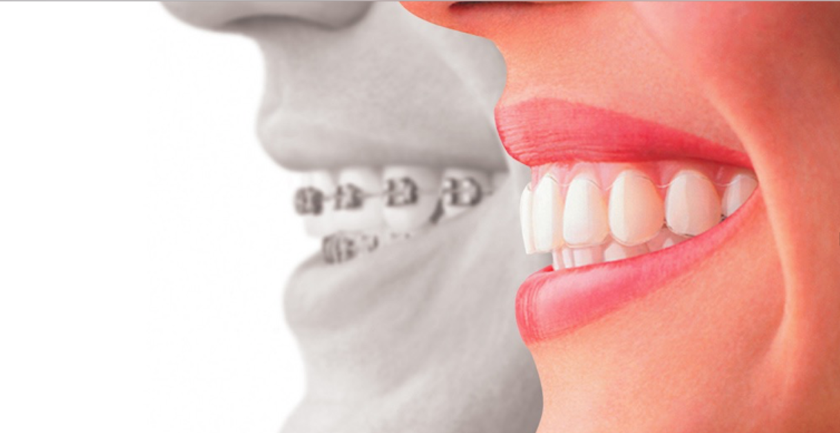smile with braces and smile with invisalign