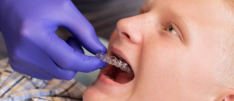 10 Things to Know Before Getting Invisalign®