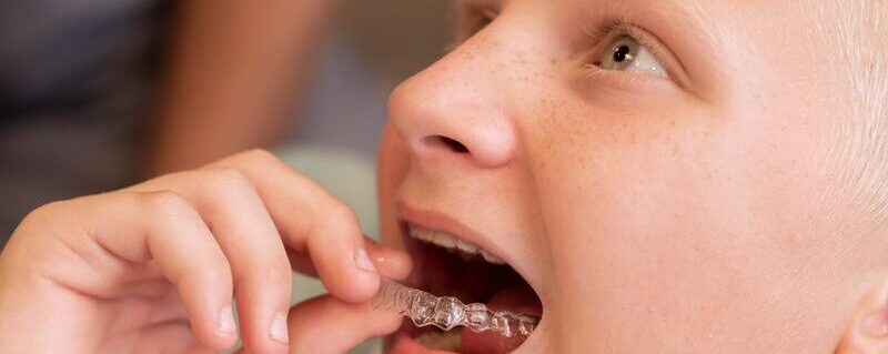 How to Clean Retainers